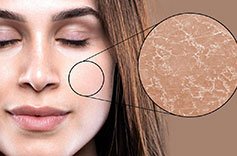Dry-skin